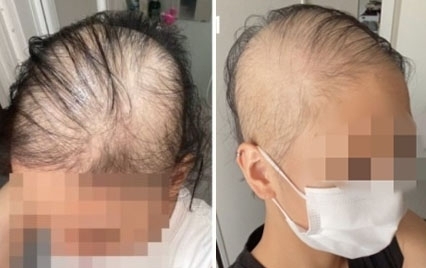일본의 한 20대 여성이 지난 6월 말 모더나 백신 1차 접종을 받은 뒤 탈모가 시작됐다며 공개한 사진. (블로그 갈무리) © 뉴스1